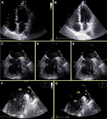 Pitfalls of Echocardiographic Image Perception: How to Overcome Them?